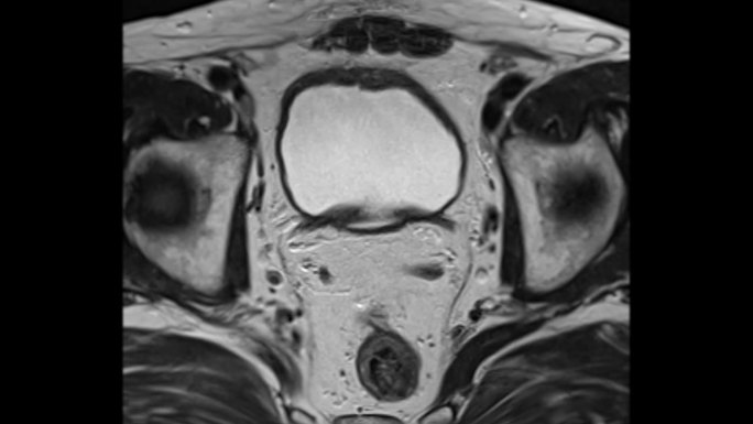 MRI前列腺轴位T2W对老年男性前列腺癌细胞的诊断价值。