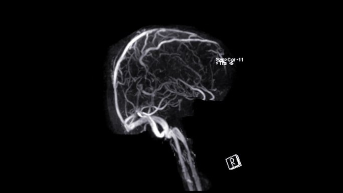 MRV脑或MR脑静脉造影。