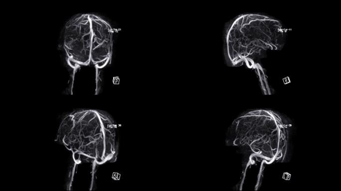 MRV脑或MR脑静脉造影。