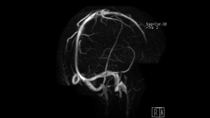 MRV脑或MR脑静脉造影。