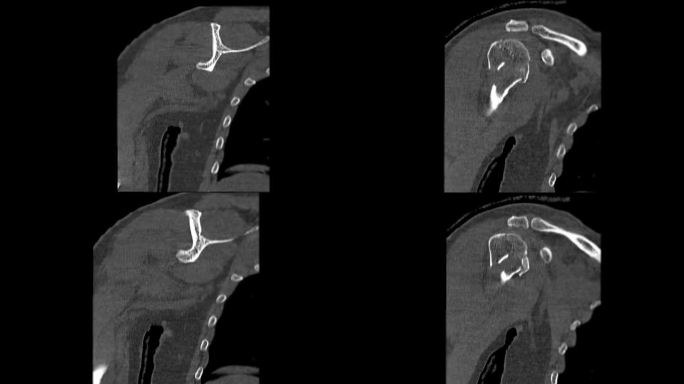 肩关节CT冠状面显示肱骨头骨折。