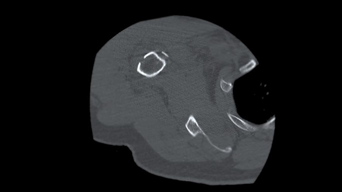 肩关节CT冠状面显示肱骨头骨折。
