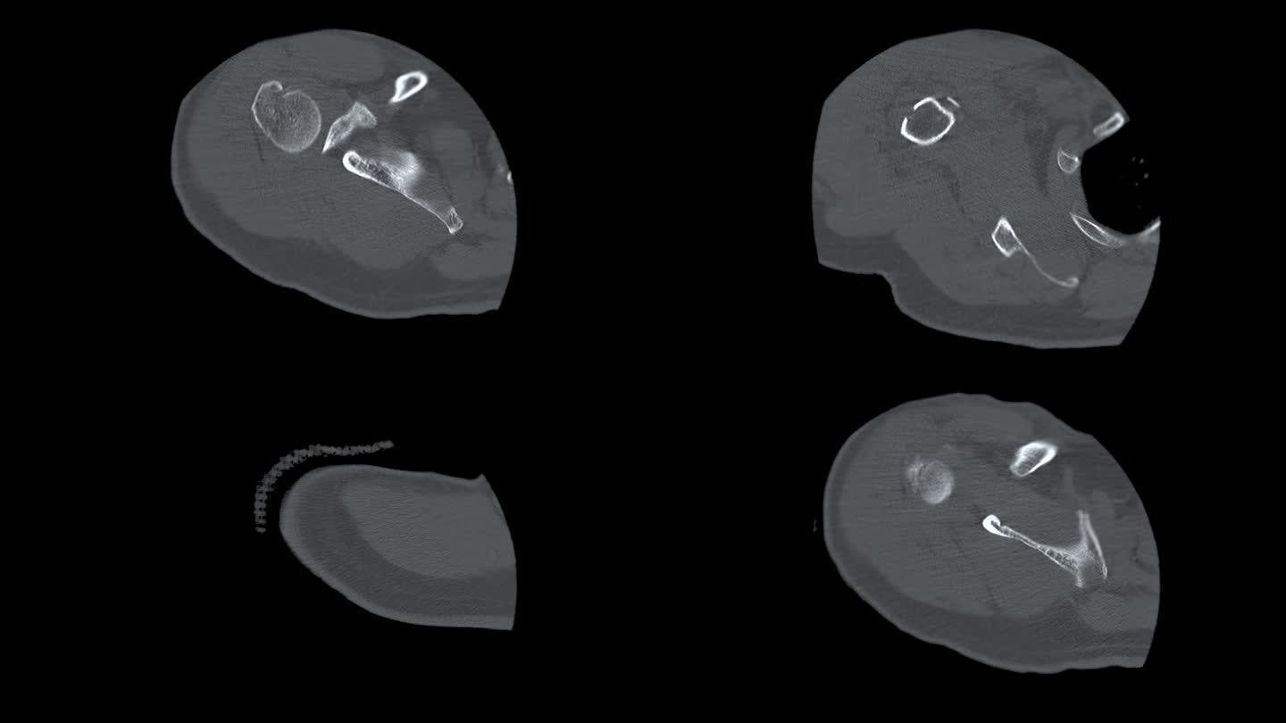肩关节CT冠状面显示肱骨头骨折。