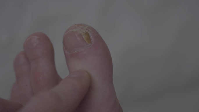 脚趾甲是真菌病变，有不健康的状况