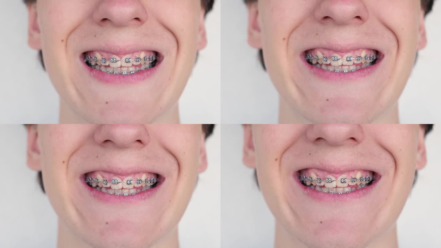 十几岁的男孩在看完牙医后戴着牙套露出牙齿