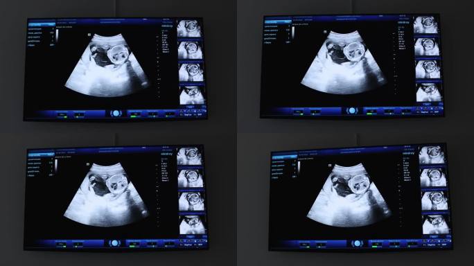 图为孕妇腹部超声仪的蓝屏。