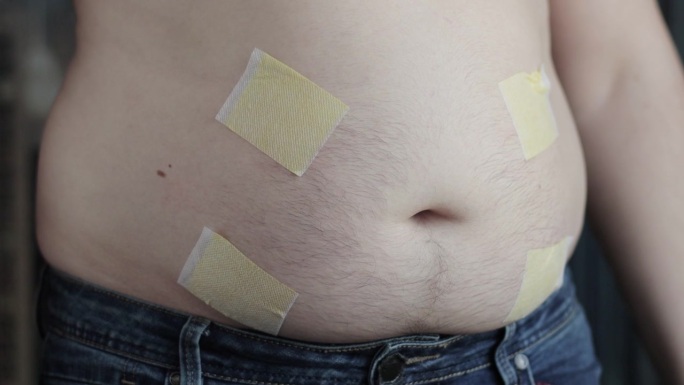 男人的肚子上贴了很多减肥用的抗脂肪组织贴片。燃烧脂肪的医用贴片。缓慢的莫