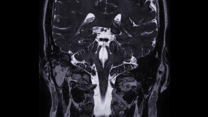 MRI内耳道(IAC)冠状面脑扫描。