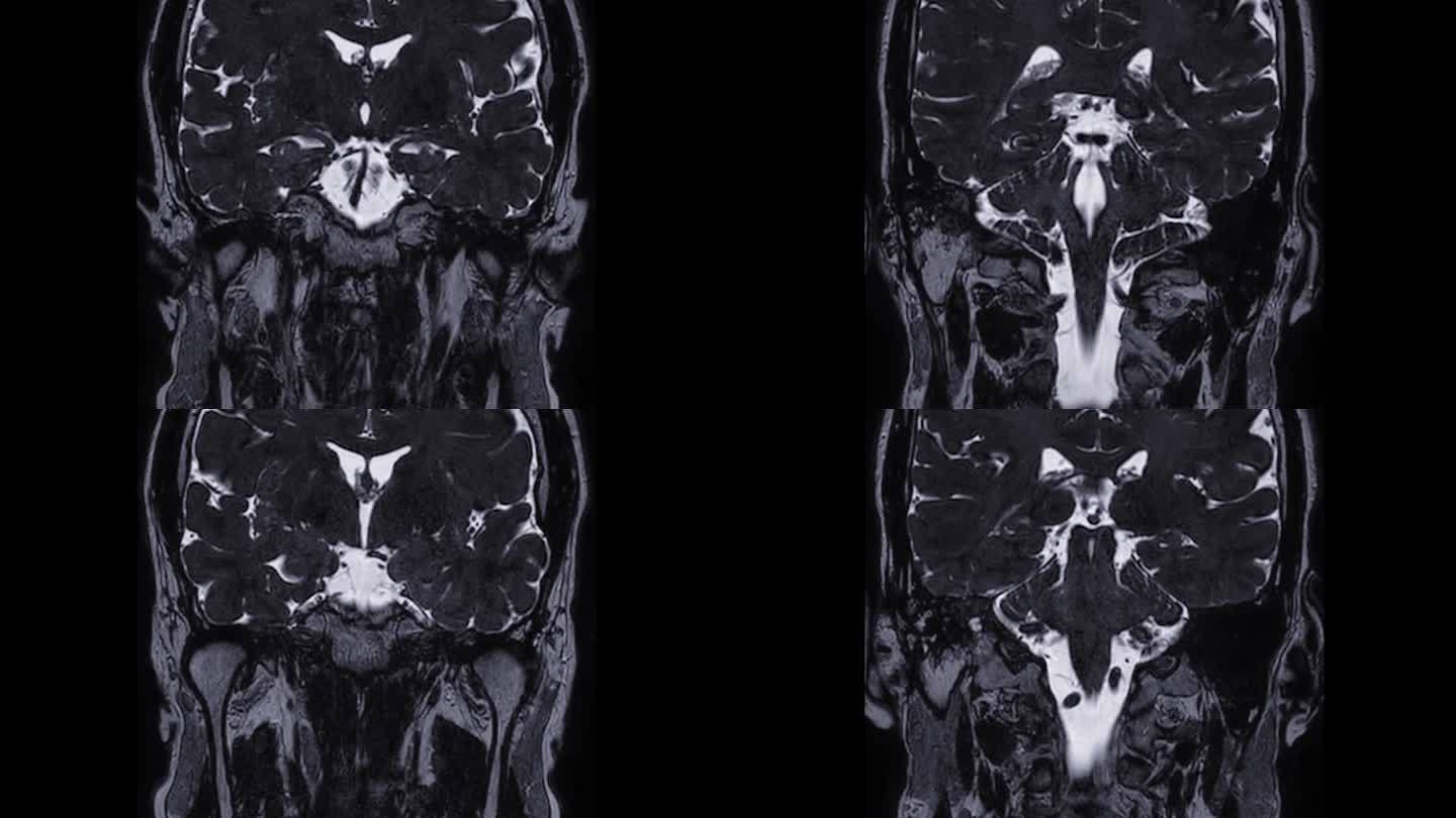MRI内耳道(IAC)冠状面脑扫描。