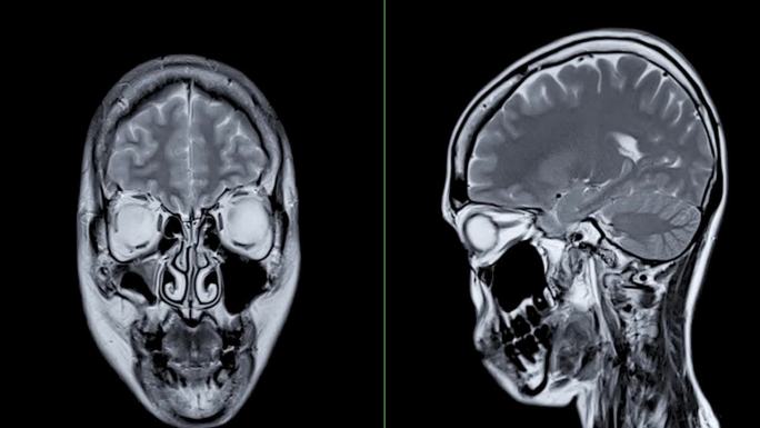 MRI脑冠状面扫描检测脑卒中疾病。