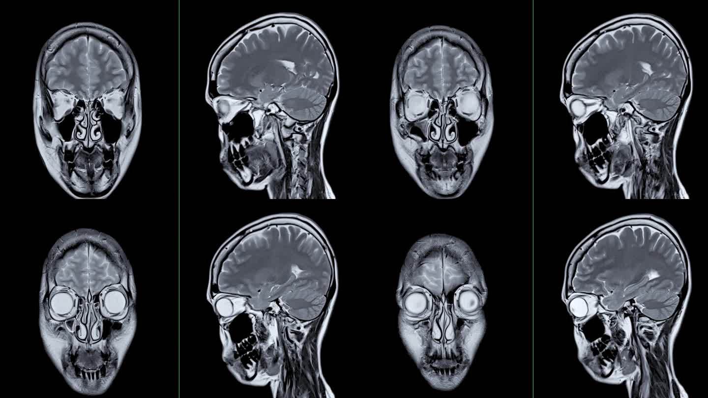 MRI脑冠状面扫描检测脑卒中疾病。