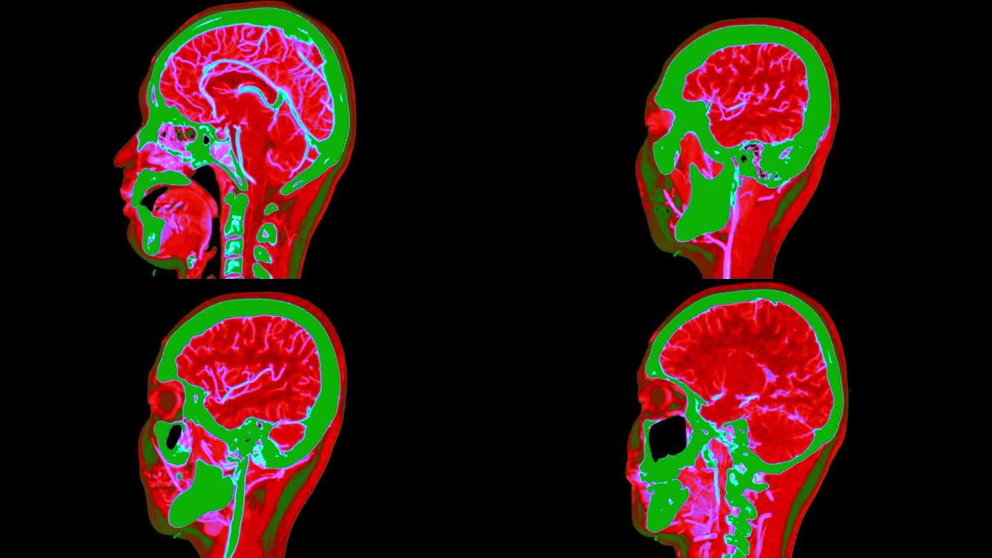 彩色模式下脑矢状面CT扫描或脑灌注诊断脑卒中疾病。