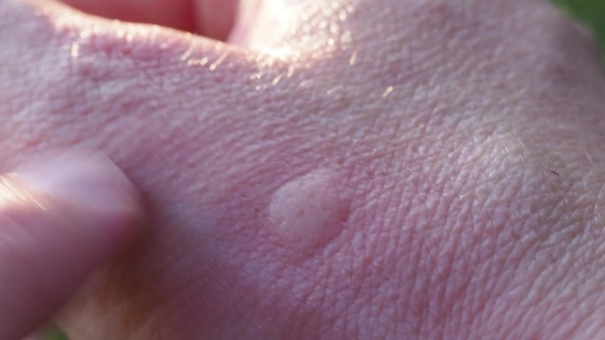 蚊子叮咬人的手的结果，极端的特写