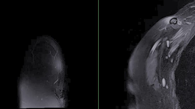 肩关节矢状位和冠状位T2FS的磁共振成像或MRI诊断肩关节疼痛。