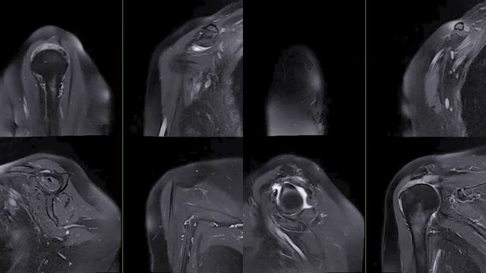 肩关节矢状位和冠状位T2FS的磁共振成像或MRI诊断肩关节疼痛。