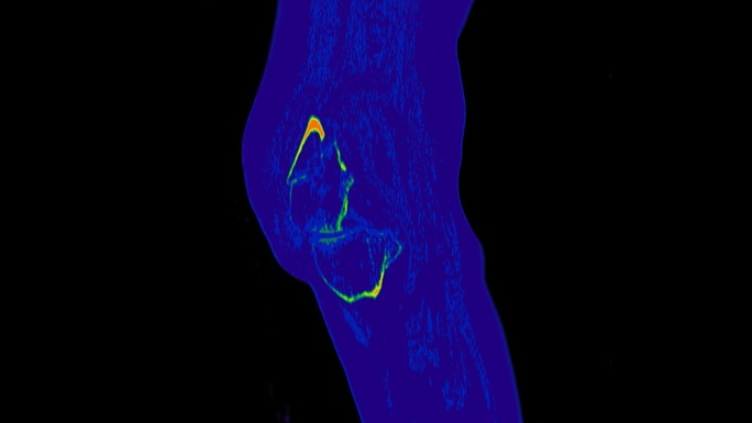 膝关节彩色模式矢状位CT扫描。