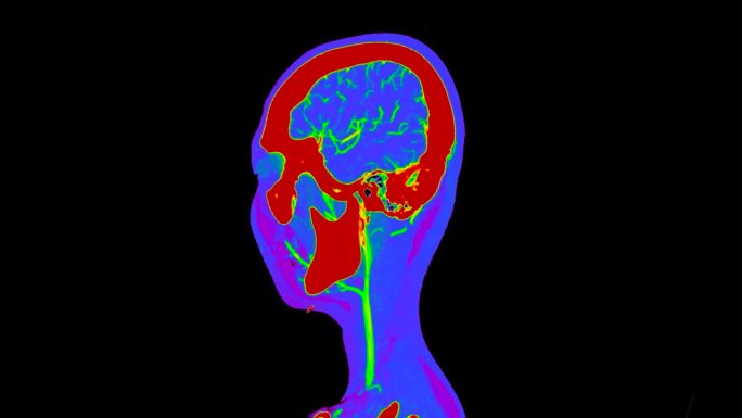 彩色模式下脑矢状面CT扫描或脑灌注诊断脑卒中疾病。