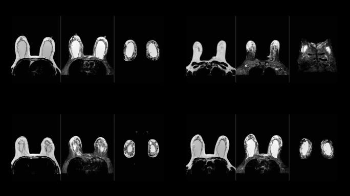 乳房核磁共振。