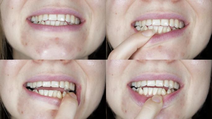 女人嘴里歪歪扭扭的牙齿。蛀牙和坏笑。牙医治疗理念。