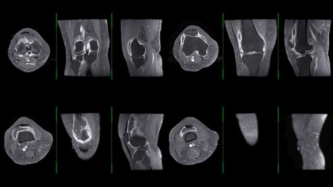 膝关节MRI或膝关节MRI轴位、冠状位、矢状位T1脂肪抑制注射钆检测膝关节肿瘤。
