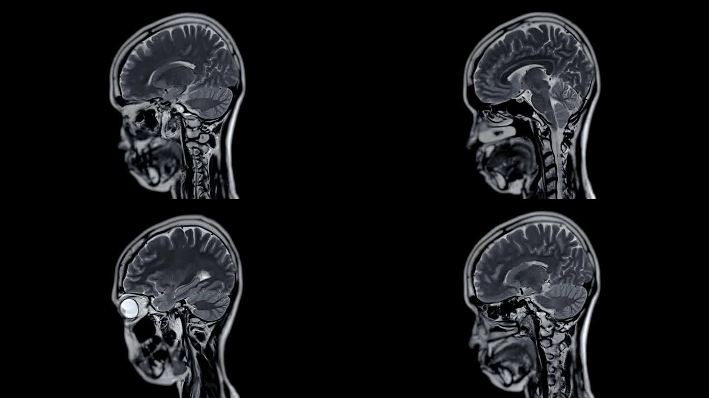 MRI脑矢状面T1W对脑卒中疾病的检测。
