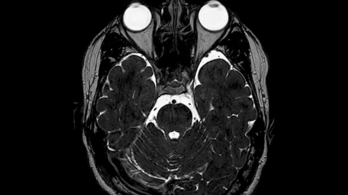 MRI内耳道(IAC)轴位图。