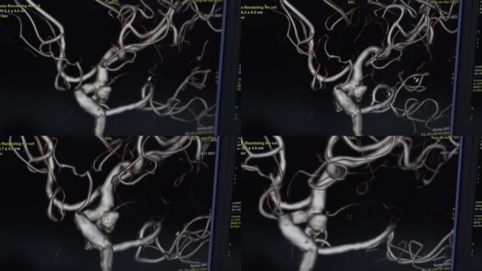 心血管介入心内科 DSA手术画面血管展示