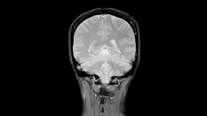 脑MRI冠状位扫描检测脑卒中疾病。