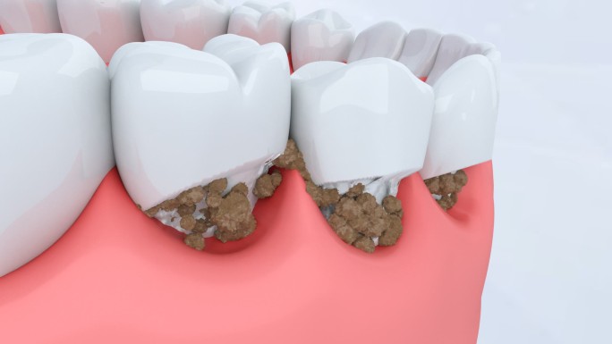 牙斑菌 龋齿 食物残渣腐蚀 牙齿 牙疼