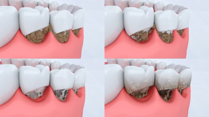 牙斑菌 龋齿 食物残渣腐蚀 牙齿 牙疼