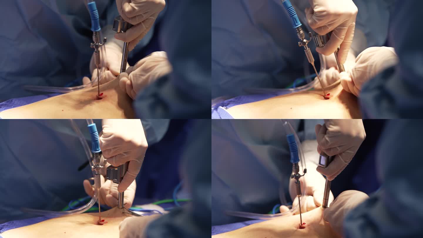 腹腔镜  手术