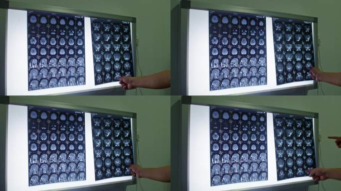 医生在观察讨论脑CT片