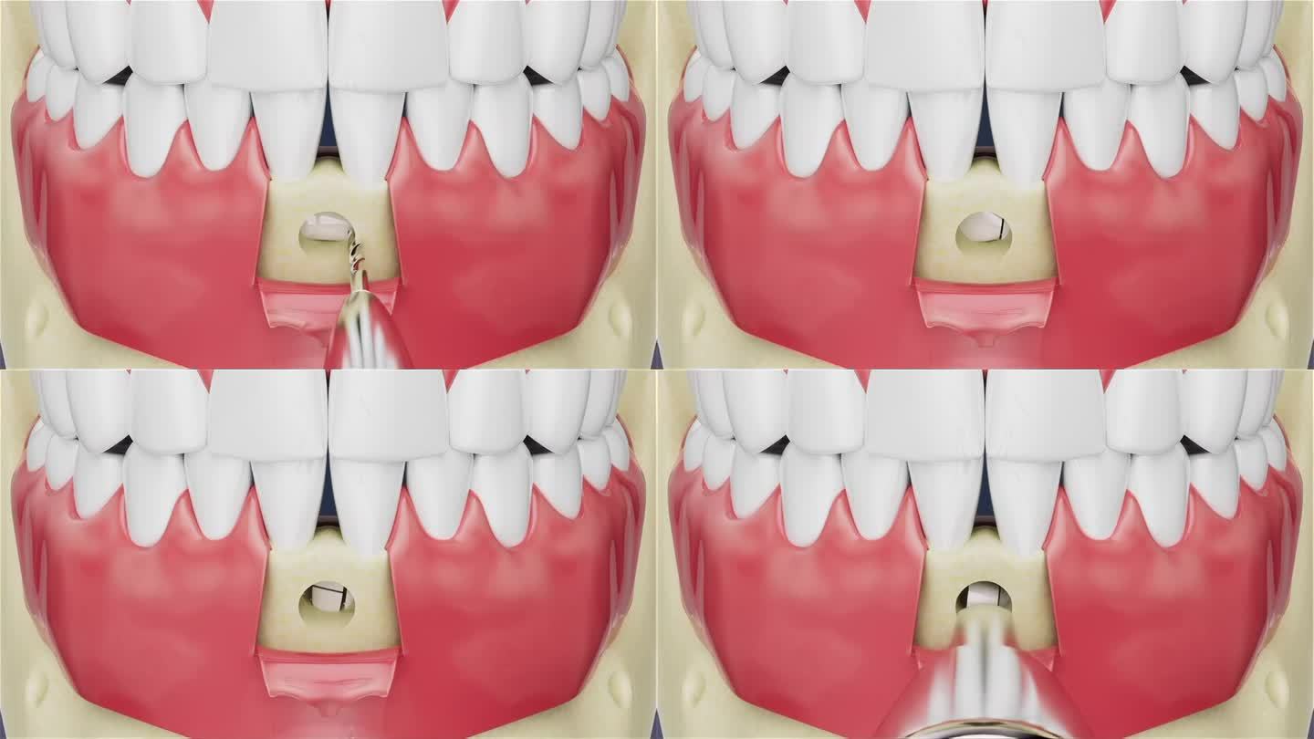异位牙拔除手术三维视频
