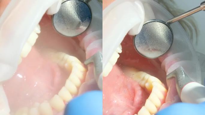 牙科妇女刷牙清洁去除牙菌斑结石唾液喷射器使用口腔镜最新技术喷砂镜水滴溅到两侧操作口扩张器