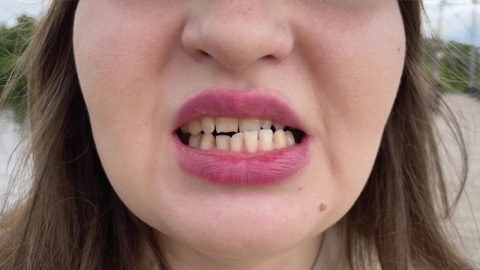 颌骨脱位、错颌、颞下颌关节功能障碍患者。她在张口闭口。
