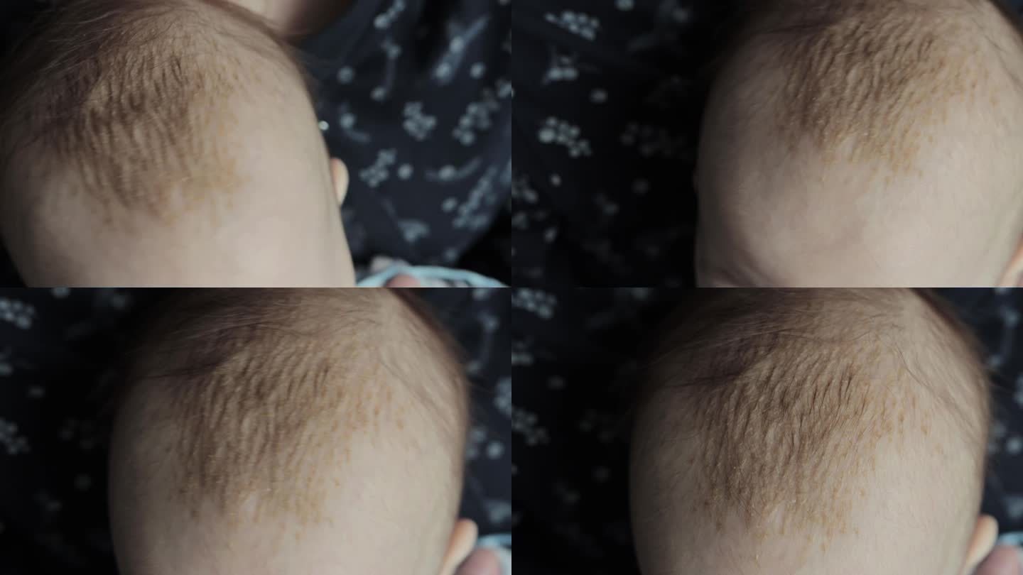 6个月大婴儿头部皮肤脂溢性皮炎。头部黄色鳞片，特写