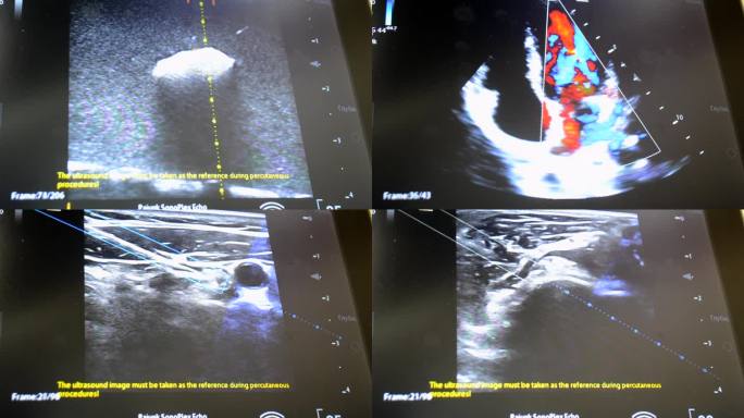 监视器上有超声波。计算机显示器屏幕上的超声图像特写。超声检查。超声超音波。超声超声。监测诊断医疗保健