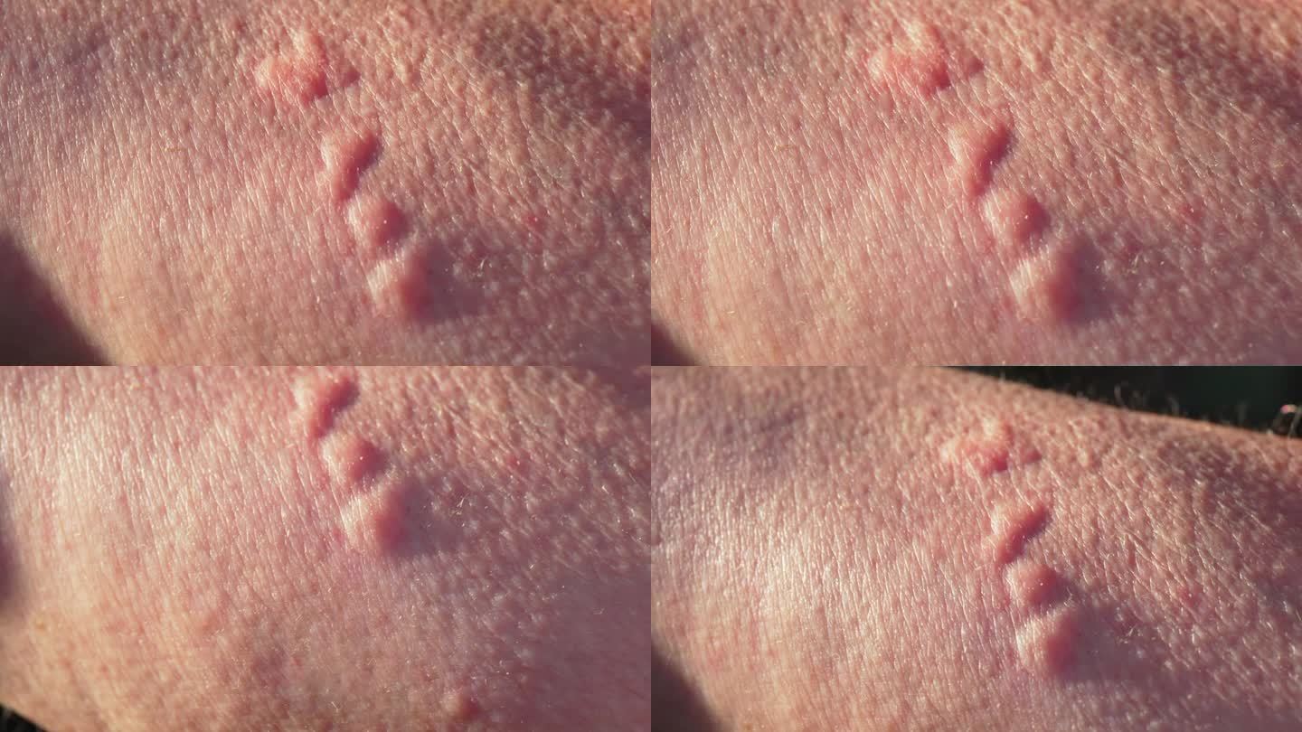 皮肤对荨麻的反应是荨麻疹。出现严重发痒的红色皮疹。