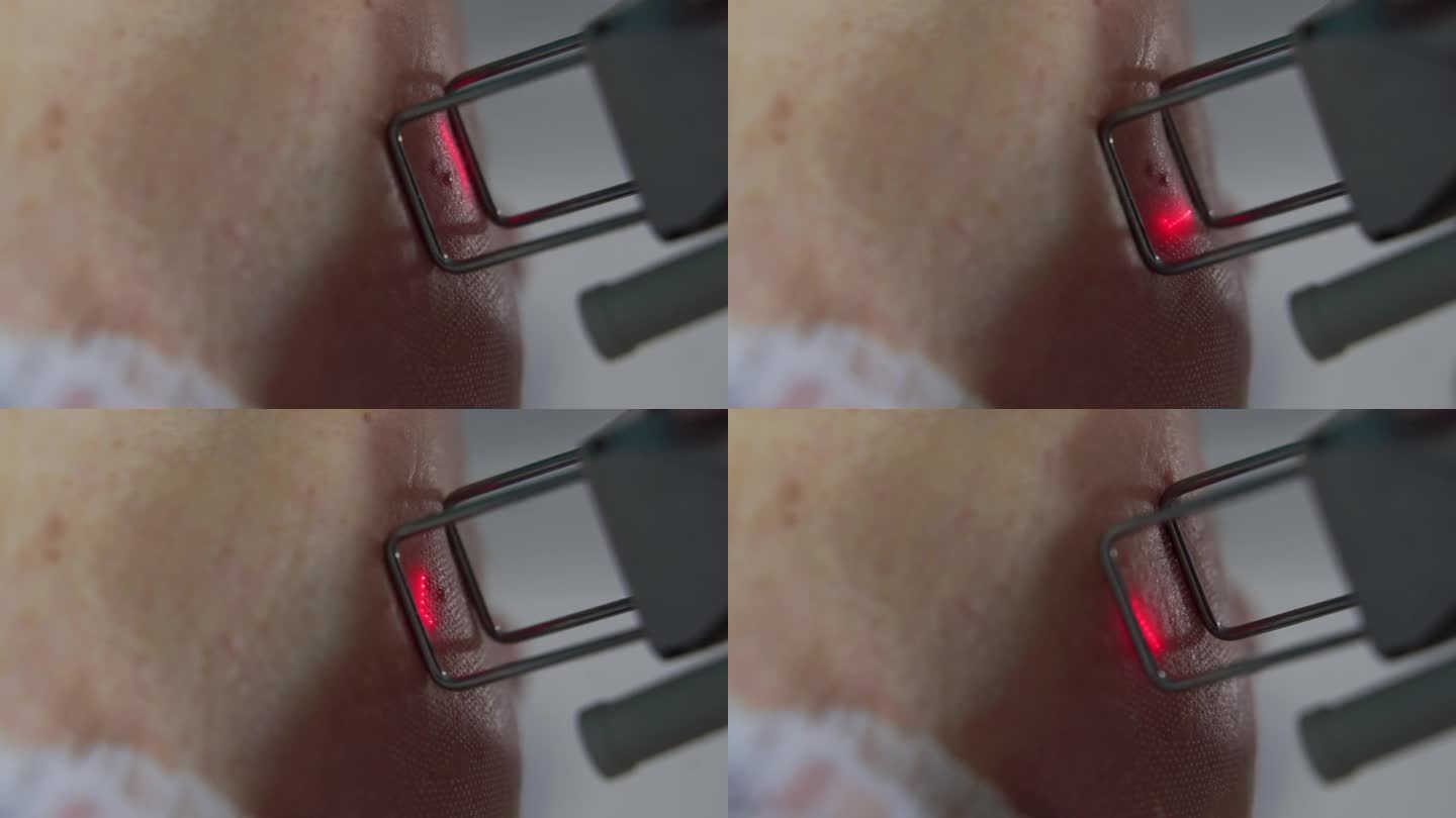 美容师正在用激光技术进行分步微针美容恢复。为客户在诊所美容院进行五金美容。