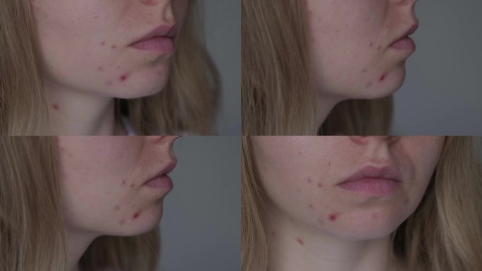 面目全非的女人露出脸上的粉刺。女性脸部特写痘痘，伴有皮疹、疤痕和斑点，对化妆品过敏。问题护肤与健康理