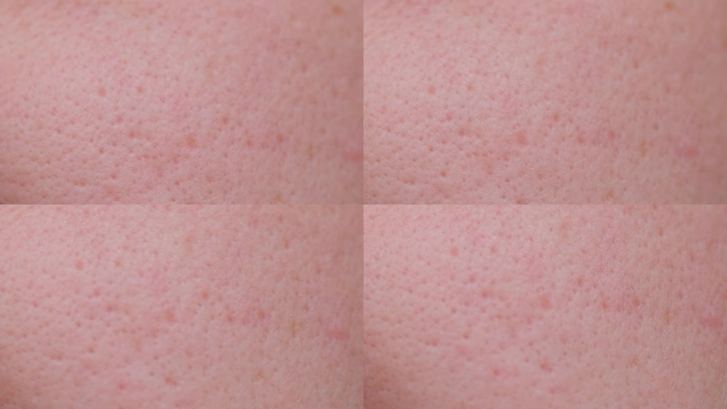 一个人的问题皮肤与自己的毛孔大，痤疮疤痕的极近距离技术。