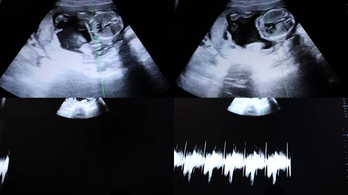 设备上孩子的心跳图。对监视器的怀孕画面进行筛选。屏幕截图。紫外线