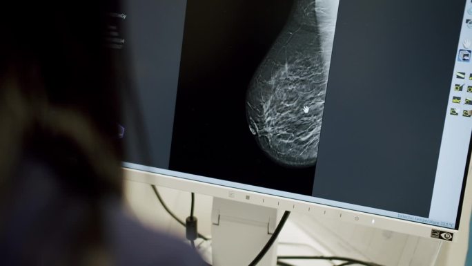 乳腺癌的诊断。妇女医用乳房x光片。