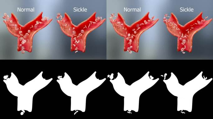 镰状细胞性贫血疾病，医学上精确的镰状细胞三维动画，血管与正常红细胞和镰状红细胞，正常血红蛋白和变形新