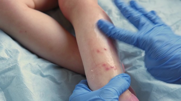 医生用手检查婴儿的腿。小孩子过敏。特写镜头。孩子抓红皮疹。护士把一种特殊的面霜涂在特应性皮肤上。宝宝