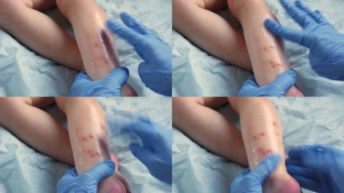 医生用手检查婴儿的腿。小孩子过敏。特写镜头。孩子抓红皮疹。护士把一种特殊的面霜涂在特应性皮肤上。宝宝