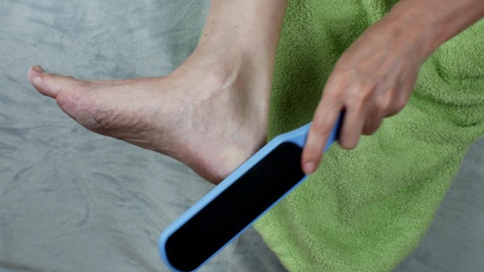 雌性用磨砂刷去脚上的角质。女性脚后跟破裂的治疗。一名妇女用塑料磨碎器对脚跟皮肤进行整容手术。愈伤组织