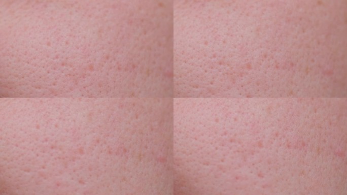 毛孔脏，黑头粉刺的主要烦恼。油性面部皮肤上毛孔粗大的微距照片。