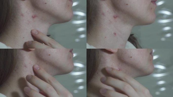 小女孩正在涂抹祛痘霜。有痤疮问题的女性的油性皮肤。脸上的伤疤和伤口。医疗保健视频。近一点，4k。