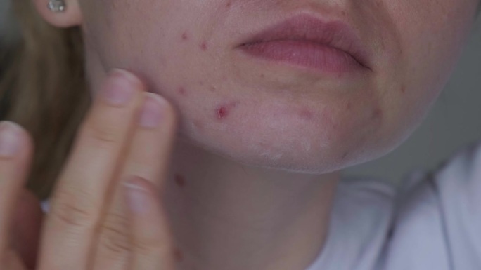 不认识的女人用化妆品，面霜精华治疗脸上的痤疮。女性脸部特写痘痘，伴有皮疹、疤痕和斑点，对化妆品过敏。